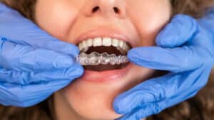 Is Invisalign Worth It?